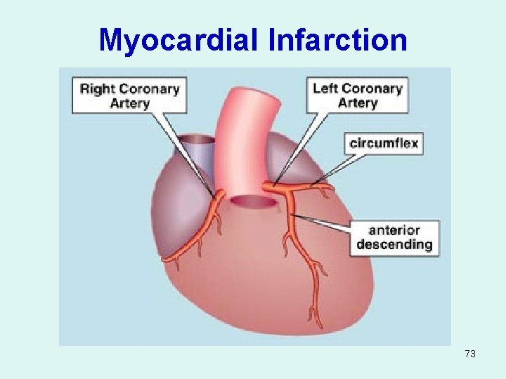 Myocardial Infarction 73 