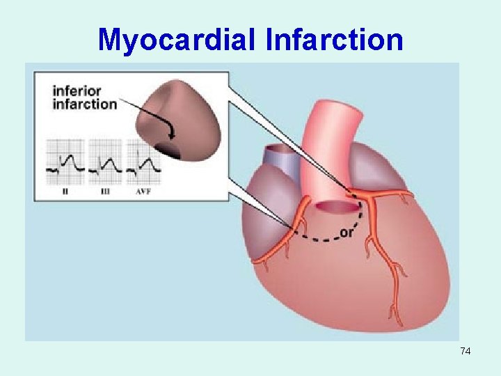 Myocardial Infarction 74 