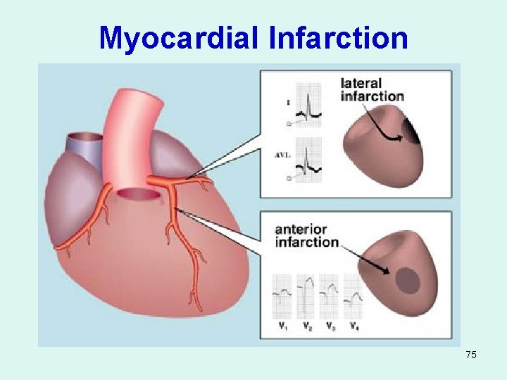 Myocardial Infarction 75 