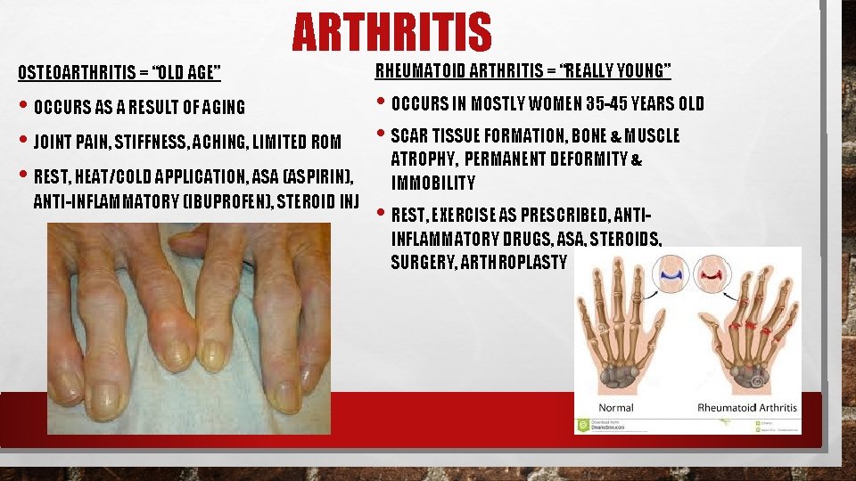 ARTHRITIS OSTEOARTHRITIS = “OLD AGE” RHEUMATOID ARTHRITIS = “REALLY YOUNG” • OCCURS IN MOSTLY