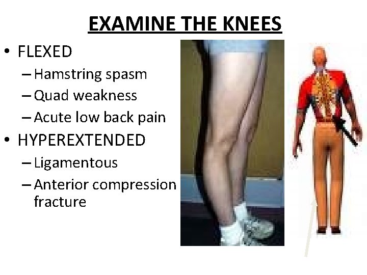 EXAMINE THE KNEES • FLEXED – Hamstring spasm – Quad weakness – Acute low