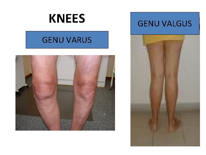 KNEES GENU VARUS GENU VALGUS 