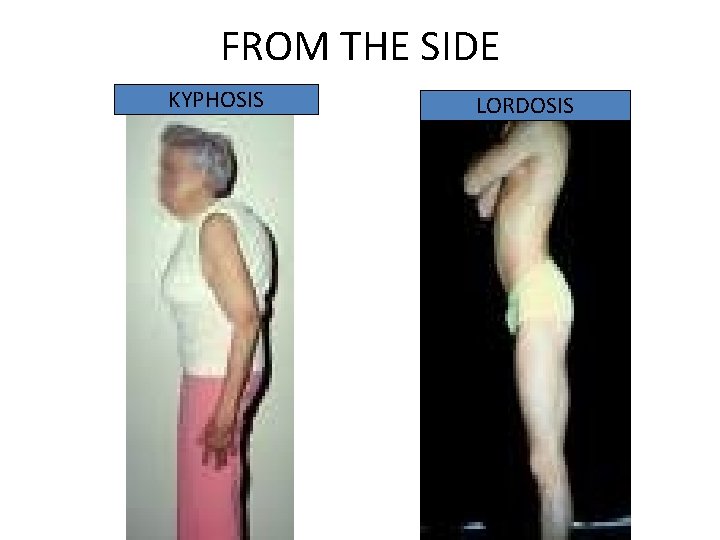 FROM THE SIDE KYPHOSIS LORDOSIS 