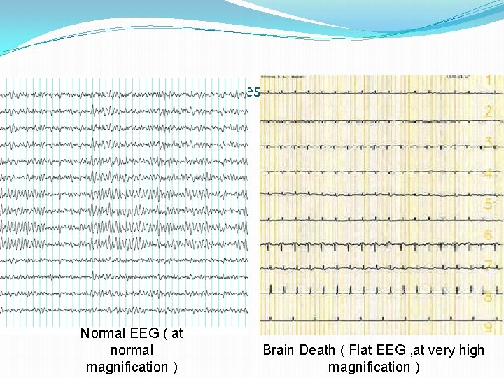 Brain Death Confirmatory Testing with EEG Normal EEG ( at normal magnification ) Brain