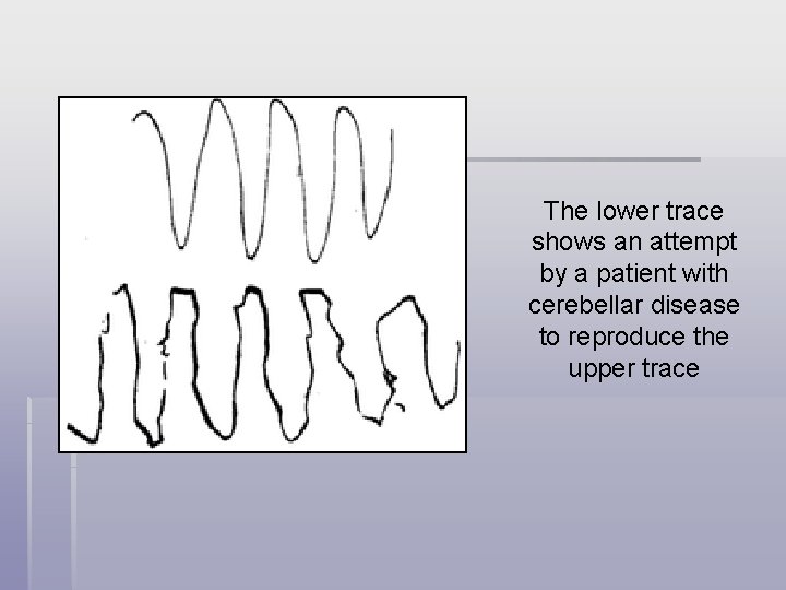 The lower trace shows an attempt by a patient with cerebellar disease to reproduce