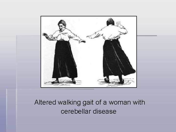 Altered walking gait of a woman with cerebellar disease 