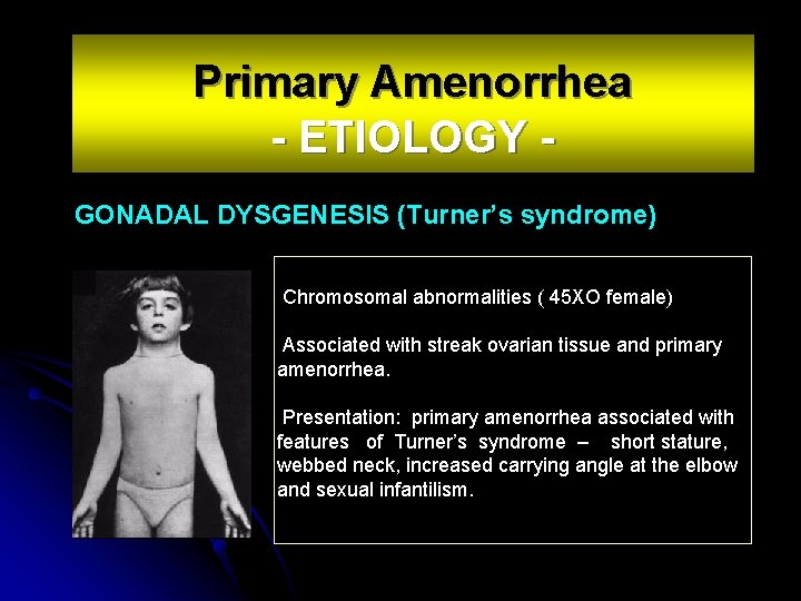 Primary Amenorrhea - ETIOLOGY GONADAL DYSGENESIS (Turner’s syndrome) Chromosomal abnormalities ( 45 XO female)