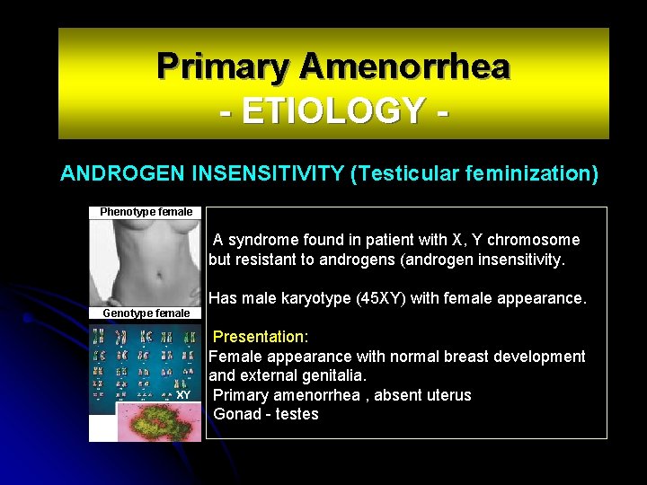 Primary Amenorrhea - ETIOLOGY ANDROGEN INSENSITIVITY (Testicular feminization) Phenotype female A syndrome found in