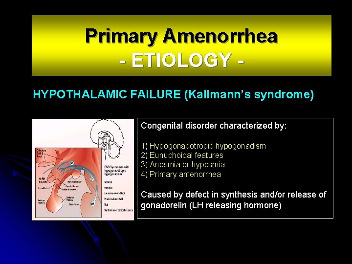 Primary Amenorrhea - ETIOLOGY HYPOTHALAMIC FAILURE (Kallmann’s syndrome) Phenotype female Congenital disorder characterized by: