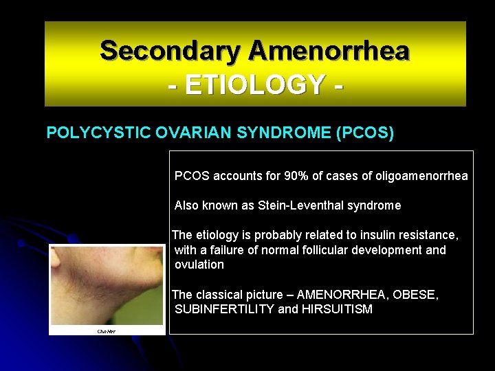 Secondary Amenorrhea - ETIOLOGY POLYCYSTIC OVARIAN SYNDROME (PCOS) PCOS accounts for 90% of cases