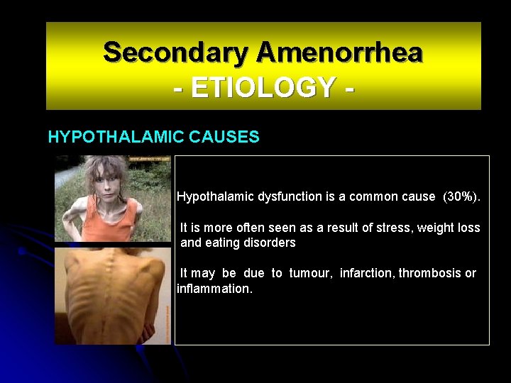 Secondary Amenorrhea - ETIOLOGY HYPOTHALAMIC CAUSES Hypothalamic dysfunction is a common cause (30%). It