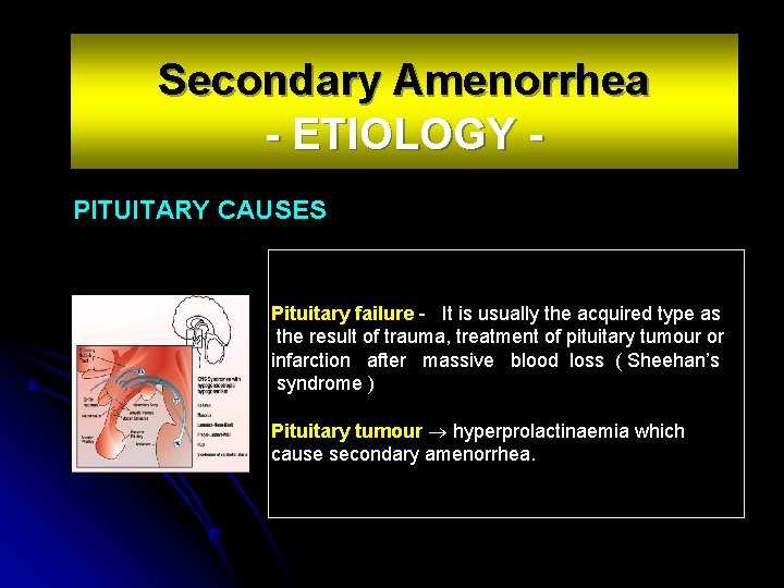 Secondary Amenorrhea - ETIOLOGY PITUITARY CAUSES Pituitary failure - It is usually the acquired