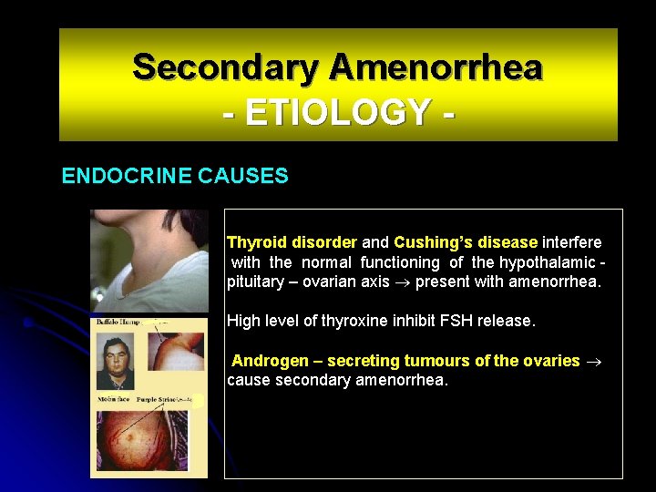 Secondary Amenorrhea - ETIOLOGY ENDOCRINE CAUSES Thyroid disorder and Cushing’s disease interfere with the