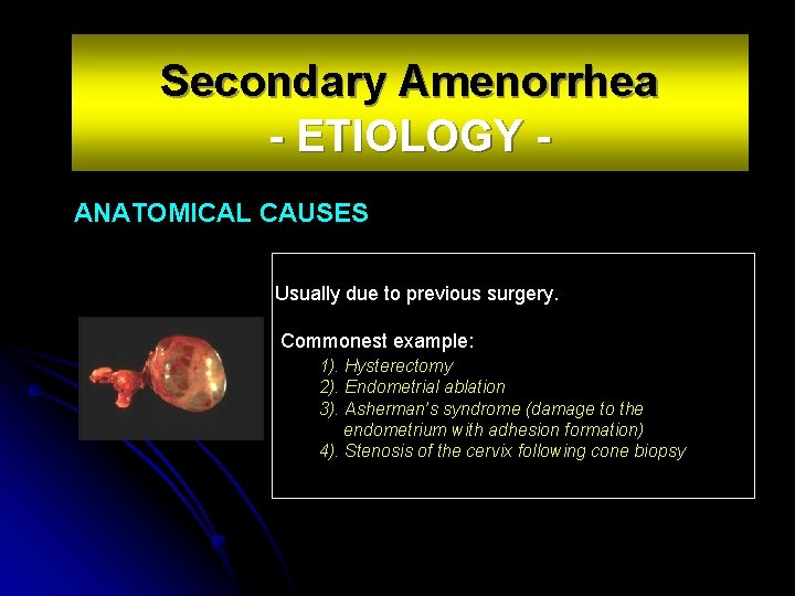 Secondary Amenorrhea - ETIOLOGY ANATOMICAL CAUSES Usually due to previous surgery. Commonest example: 1).