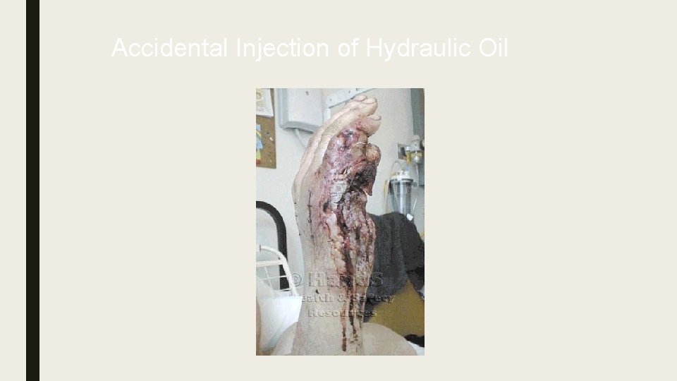 Accidental Injection of Hydraulic Oil 