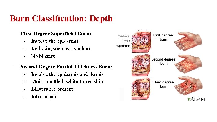 Burn Classification: Depth - First-Degree Superficial Burns - Involve the epidermis - Red skin,