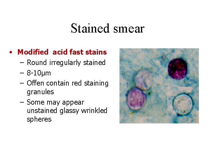 Stained smear • Modified acid fast stains – Round irregularly stained – 8 -10µm