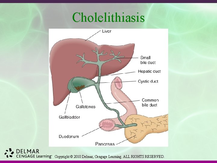 Cholelithiasis Copyright © 2010 Delmar, Cengage Learning. ALL RIGHTS RESERVED. 