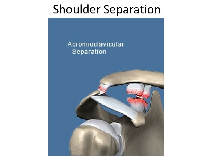 Shoulder Separation 