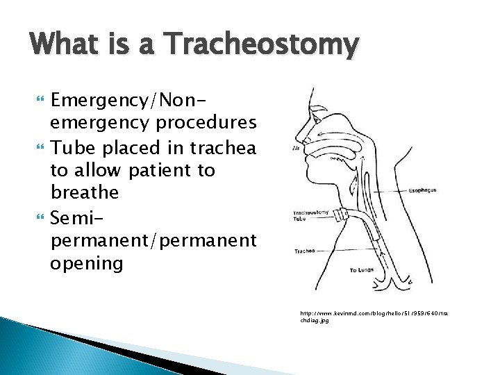 What is a Tracheostomy Emergency/Nonemergency procedures Tube placed in trachea to allow patient to