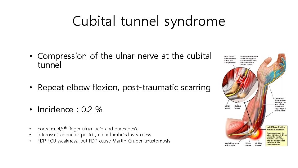 Cubital tunnel syndrome • Compression of the ulnar nerve at the cubital tunnel •