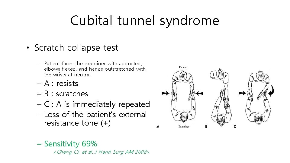 Cubital tunnel syndrome • Scratch collapse test – Patient faces the examiner with adducted,