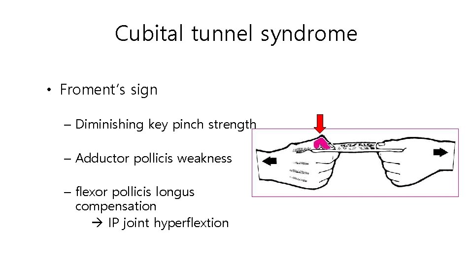 Cubital tunnel syndrome • Froment’s sign – Diminishing key pinch strength – Adductor pollicis