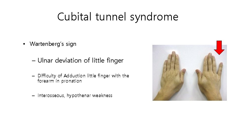 Cubital tunnel syndrome • Wartenberg’s sign – Ulnar deviation of little finger – Difficulty