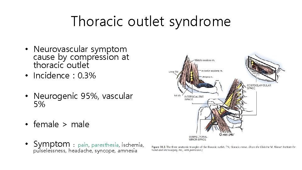 Thoracic outlet syndrome • Neurovascular symptom cause by compression at thoracic outlet • Incidence