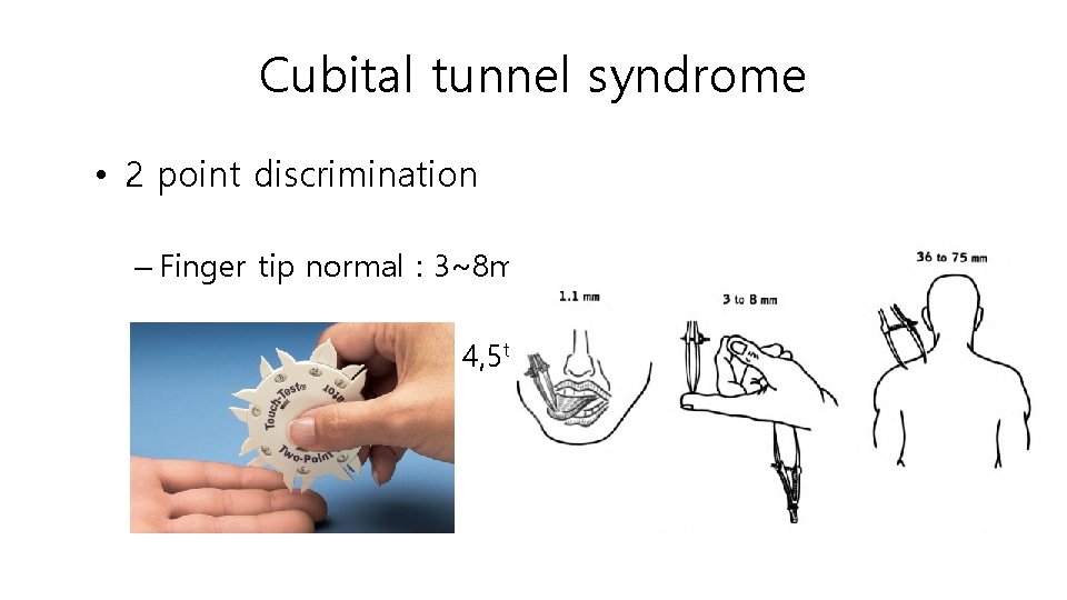 Cubital tunnel syndrome • 2 point discrimination – Finger tip normal : 3~8 mm