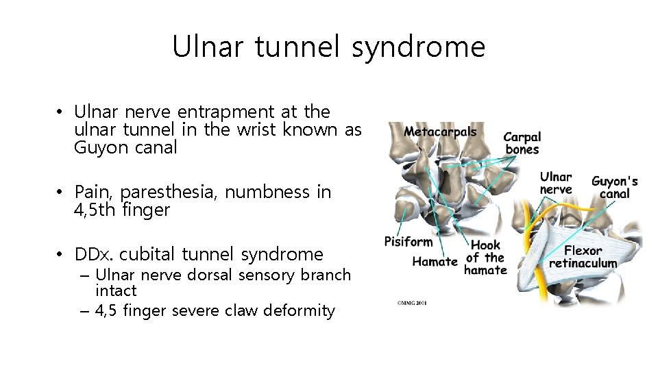 Ulnar tunnel syndrome • Ulnar nerve entrapment at the ulnar tunnel in the wrist