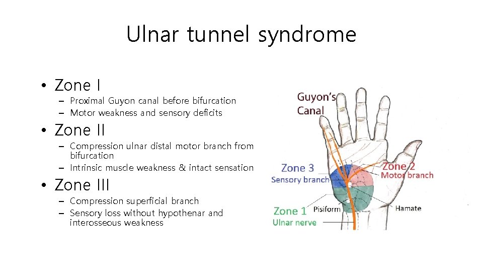 Ulnar tunnel syndrome • Zone I – Proximal Guyon canal before bifurcation – Motor