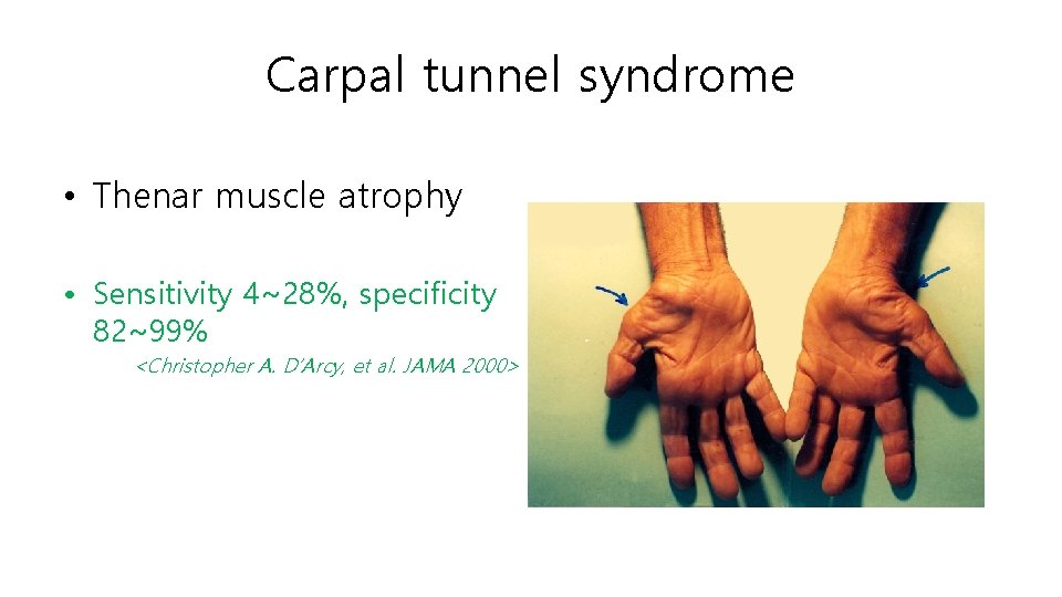 Carpal tunnel syndrome • Thenar muscle atrophy • Sensitivity 4~28%, specificity 82~99% <Christopher A.