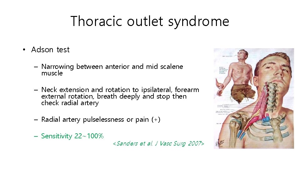 Thoracic outlet syndrome • Adson test – Narrowing between anterior and mid scalene muscle