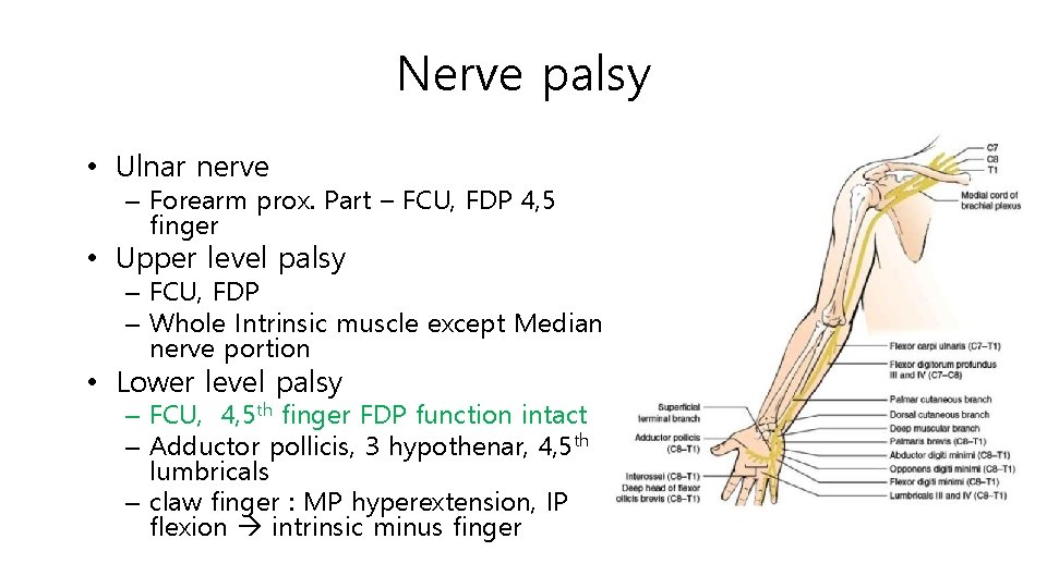 Nerve palsy • Ulnar nerve – Forearm prox. Part – FCU, FDP 4, 5