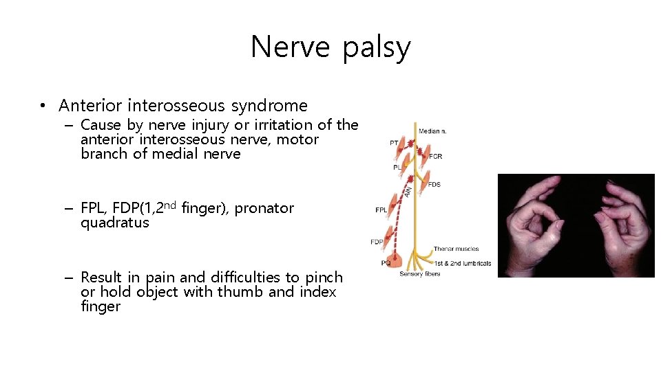 Nerve palsy • Anterior interosseous syndrome – Cause by nerve injury or irritation of