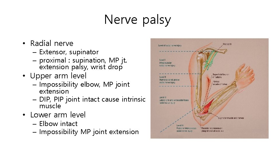 Nerve palsy • Radial nerve – Extensor, supinator – proximal : supination, MP jt.