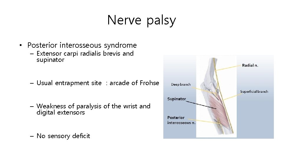 Nerve palsy • Posterior interosseous syndrome – Extensor carpi radialis brevis and supinator –