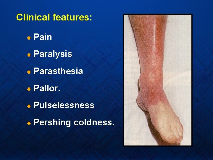 Clinical features: Pain Paralysis Parasthesia Pallor. Pulselessness Pershing coldness. 