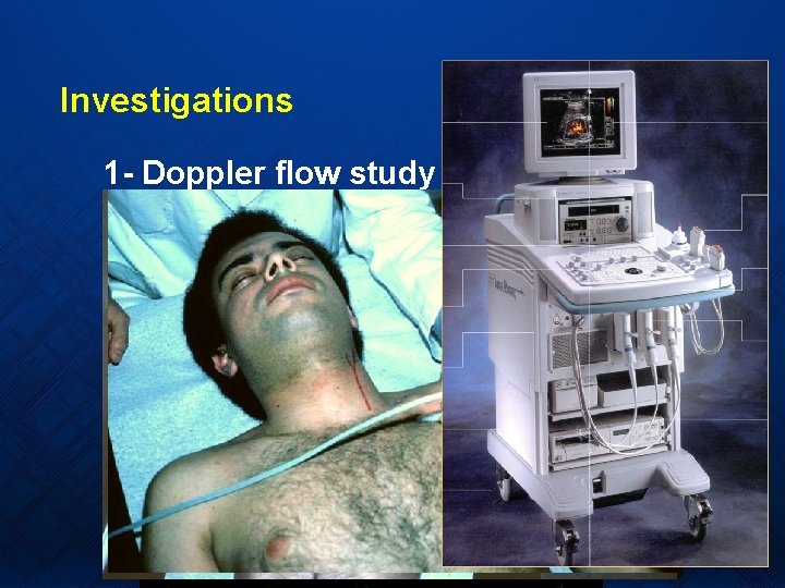 Investigations 1 - Doppler flow study 2 - Duplex ultrasound. 3 - Arteriography. 4