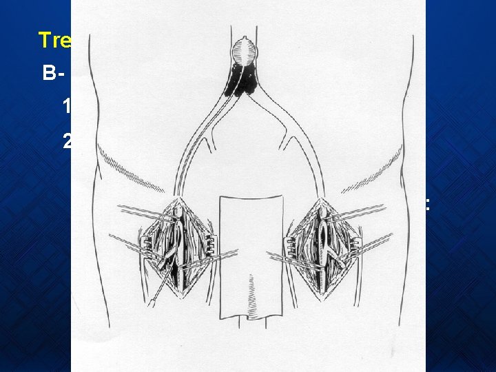 Treatment B- Specific measures 1 - Embolism: Urgent embolectomy. 2 - Acute Thrombosis: Thrombolytic