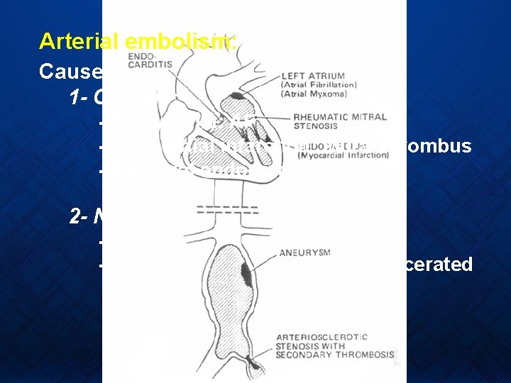 Arterial embolism: Causes: 1 - Cardiac: - Arrhythmia: AF - Myocardial infarction: Mural thrombus