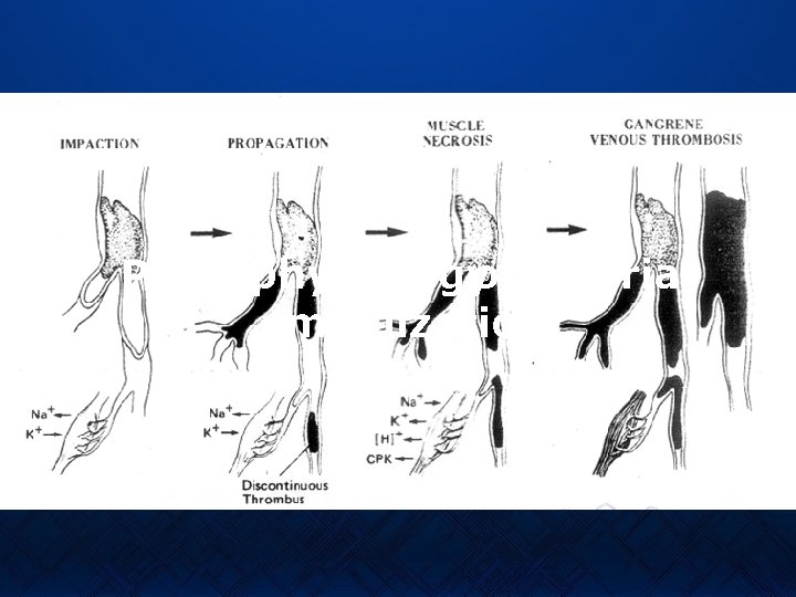 Pathophysiologyof arterial embolization. 