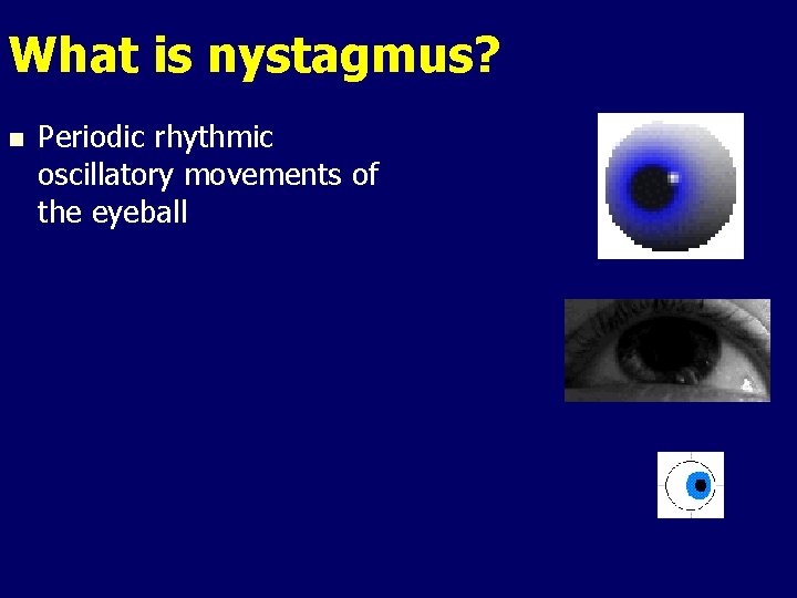 What is nystagmus? n Periodic rhythmic oscillatory movements of the eyeball What is nystagmus? n Periodic rhythmic oscillatory movements of the eyeball