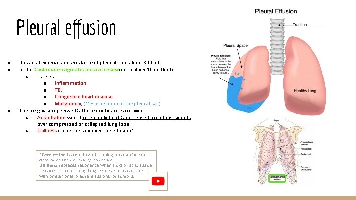 Pleural effusion ● ● ● It is an abnormal accumulationof pleural fluid about 300