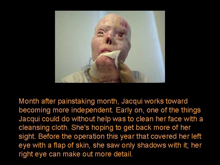 Month after painstaking month, Jacqui works toward becoming more independent. Early on, one of