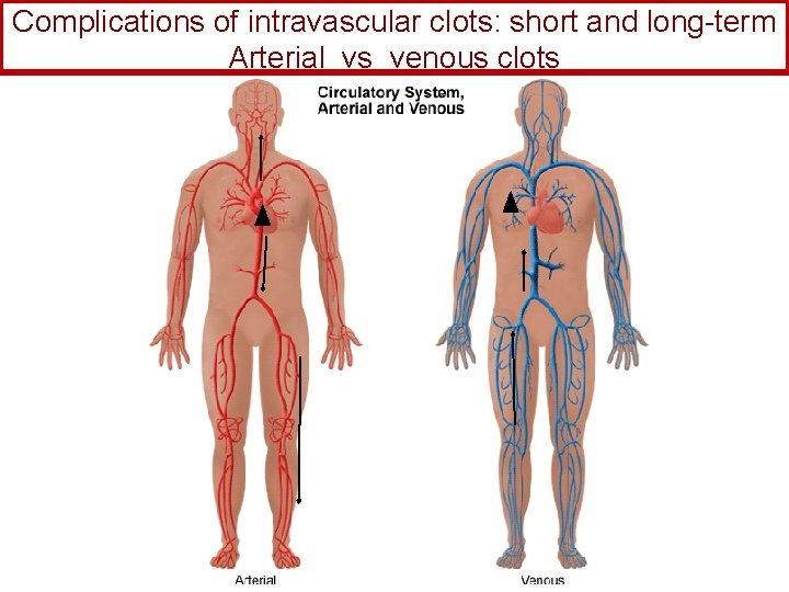 Complications of intravascular clots: short and long-term Arterial vs venous clots 