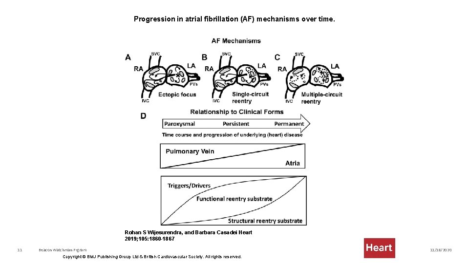 Progression in atrial fibrillation (AF) mechanisms over time. Rohan S Wijesurendra, and Barbara Casadei
