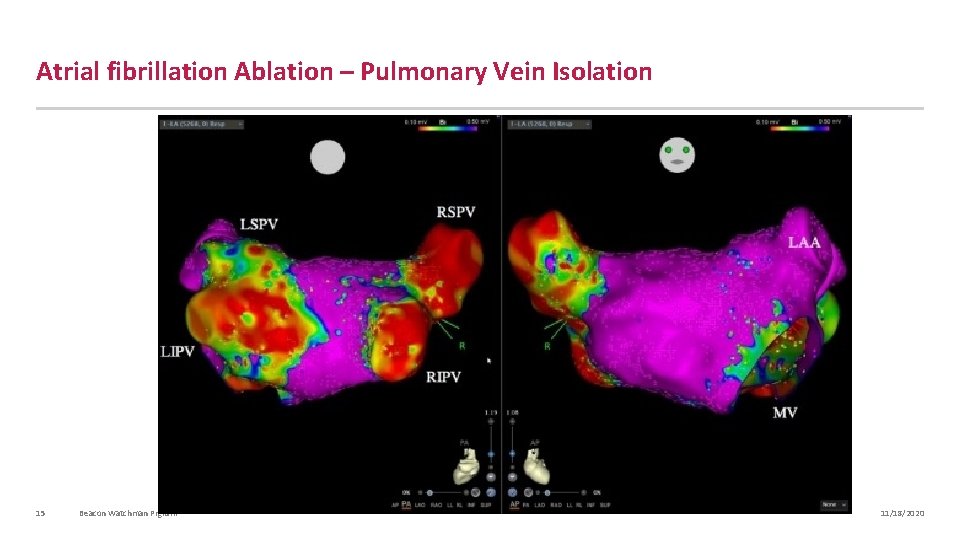 Atrial fibrillation Ablation – Pulmonary Vein Isolation 15 Beacon Watchman Prgram 11/18/2020 