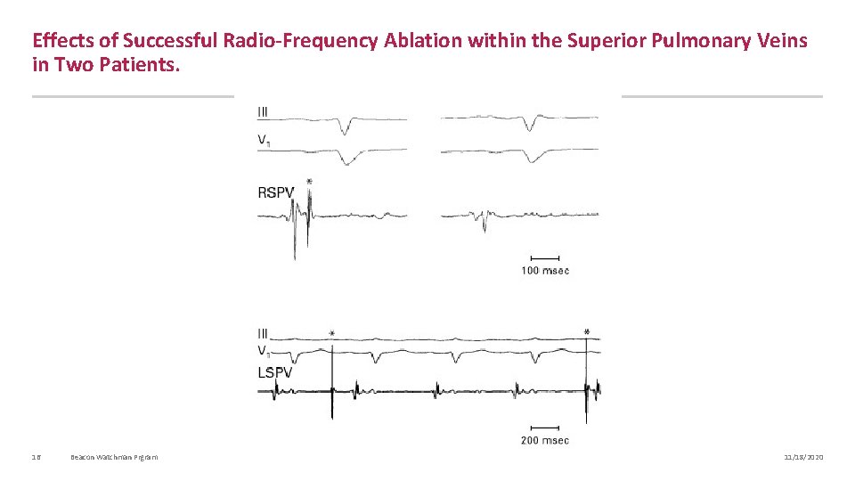 Effects of Successful Radio-Frequency Ablation within the Superior Pulmonary Veins in Two Patients. 16
